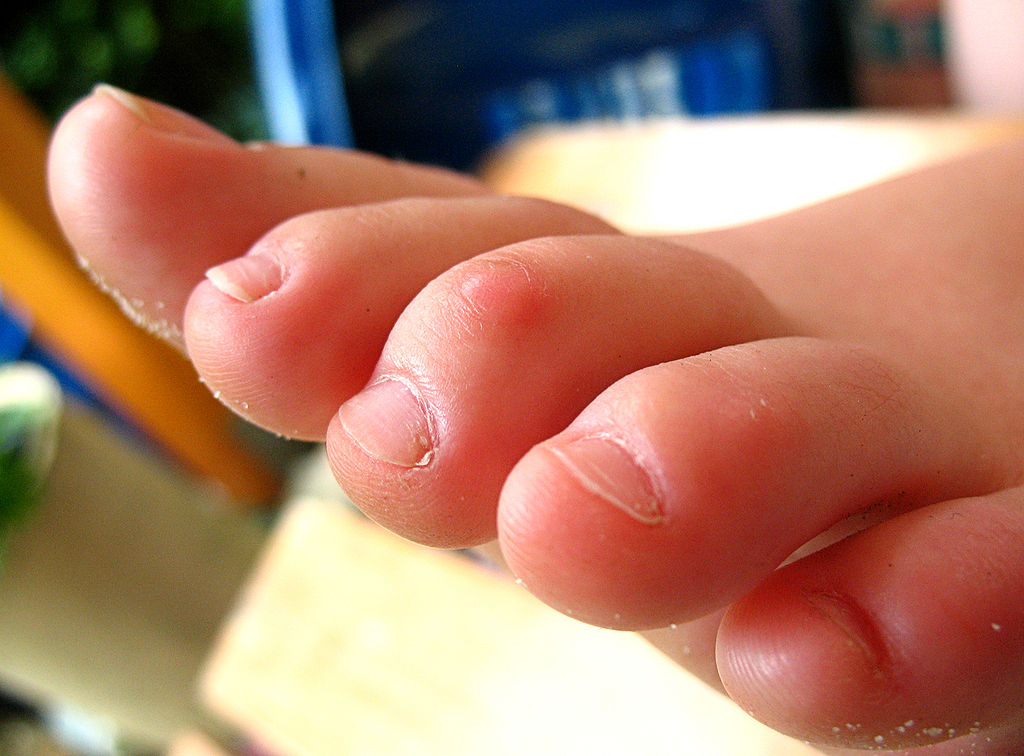 Đi dép xỏ ngón lâu có thể khiến ngón chân bị biến dạng